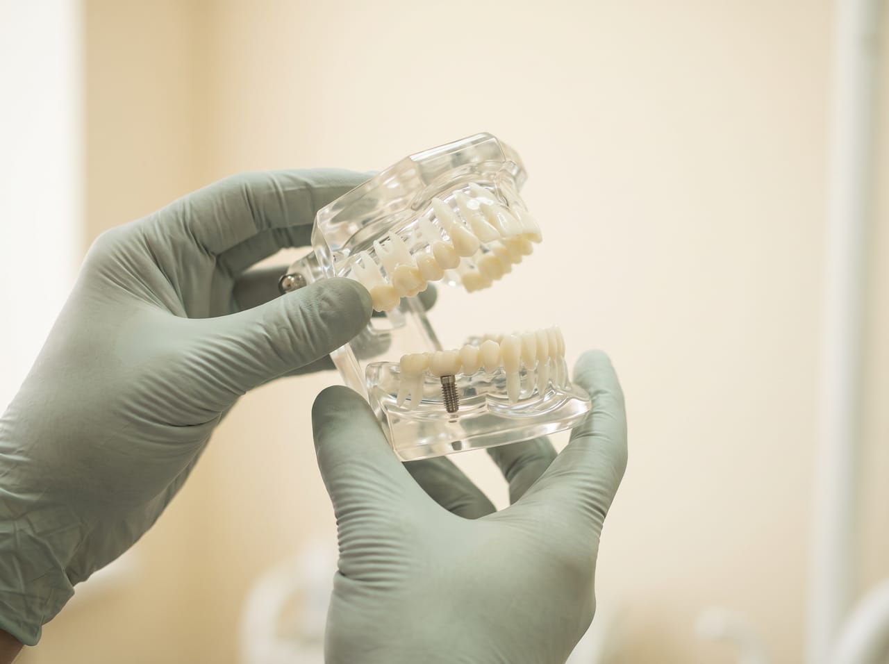 Gloved hands holding a clear jaw model with a dental implant in soft bright light
